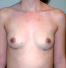 Transumbilical Breast Augmentation before 1