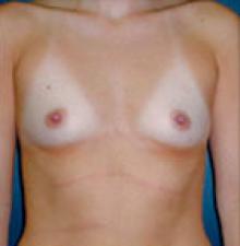 Transumbilical Breast Augmentation before 3