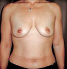 Transumbilical Breast Augmentation before 4