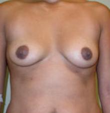 Transumbilical Breast Augmentation before 6