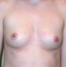 Transumbilical Breast Augmentation before 8