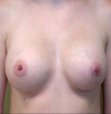 Transumbilical Breast Augmentation after 8
