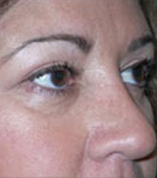 Eyelid Lift after 1
