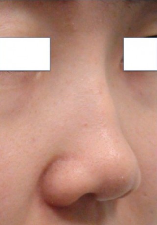 Non Surgical Rhinoplasty before 0