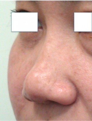 Non Surgical Rhinoplasty before 1