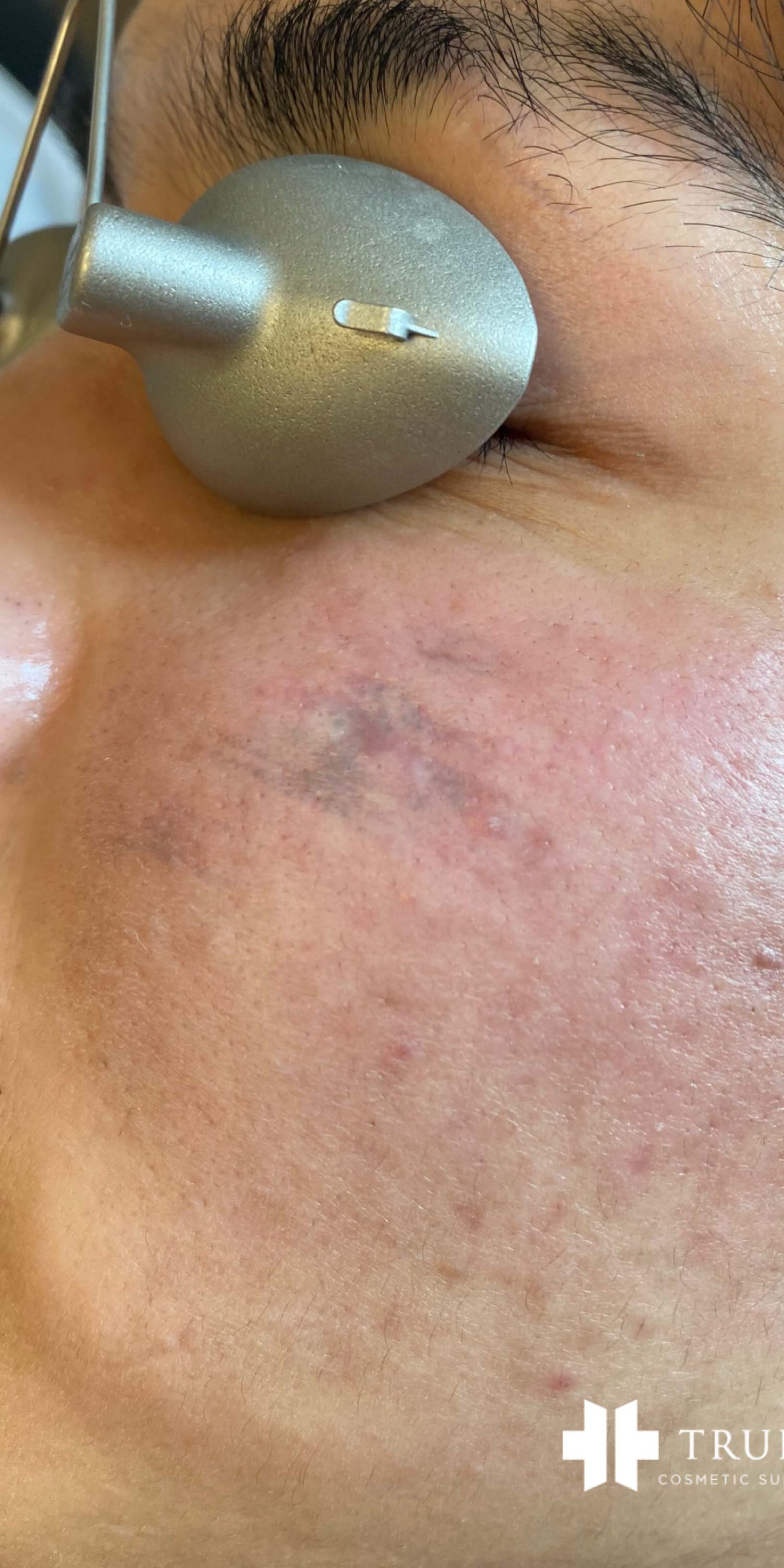 Picoway Laser before 0