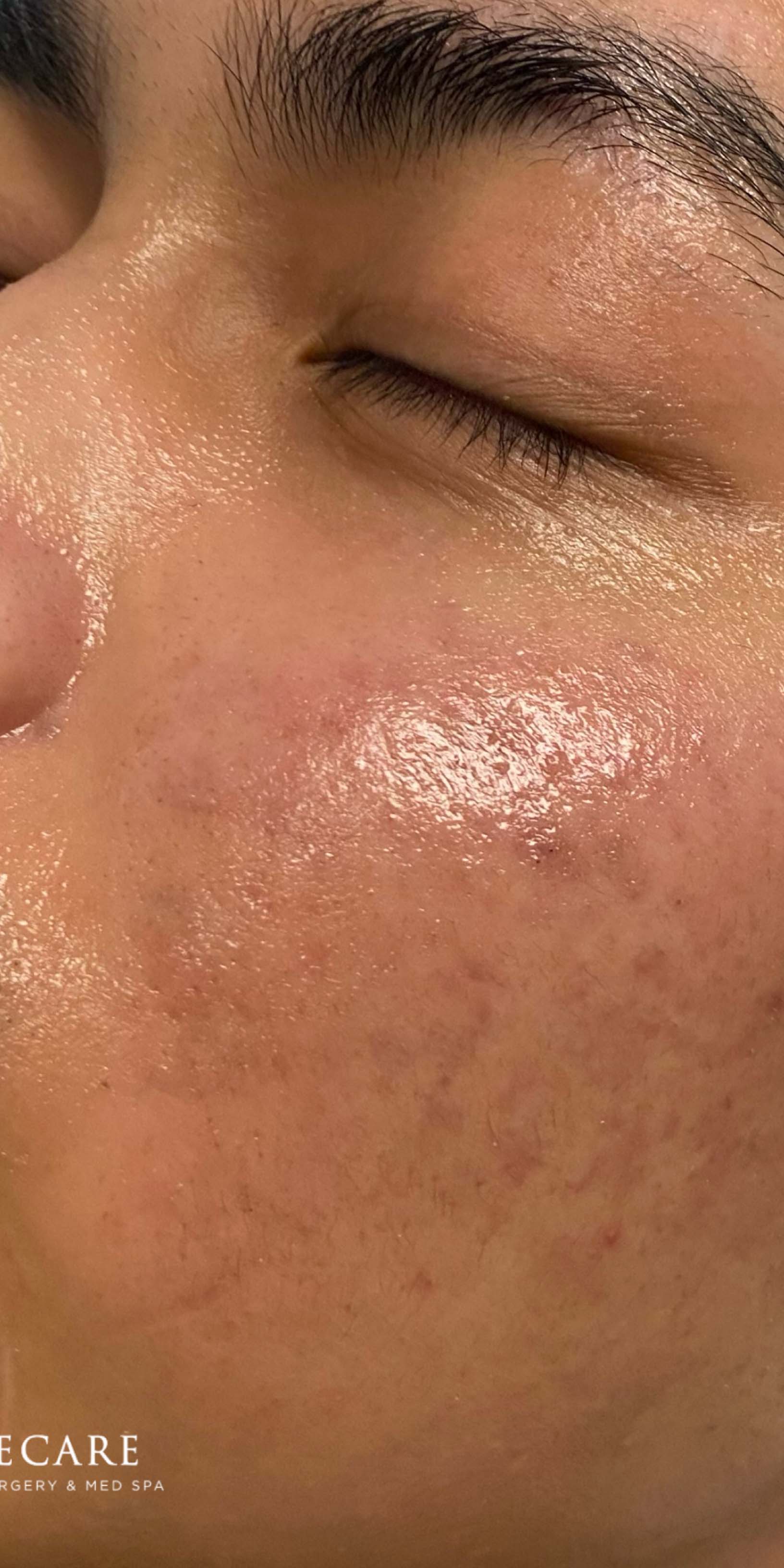 Picoway Laser after 0