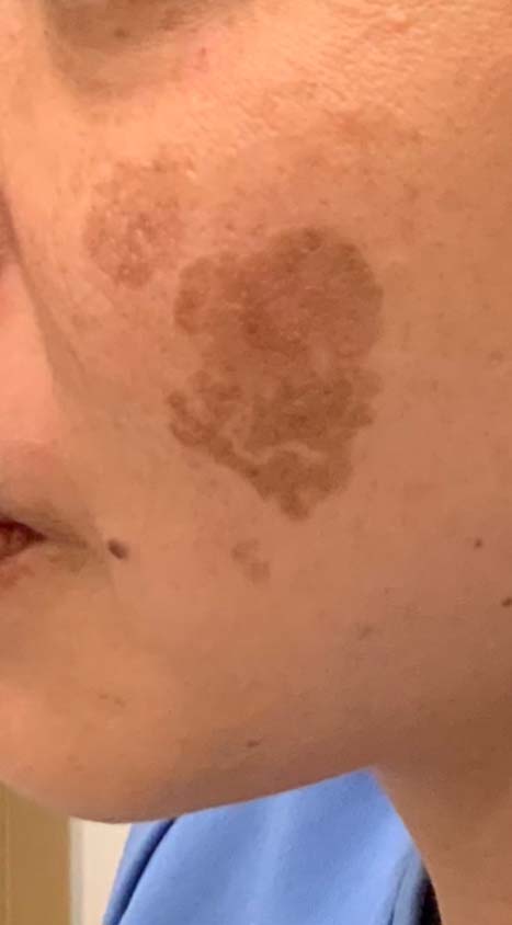 Picoway Laser before 1