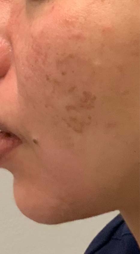 Picoway Laser after 1