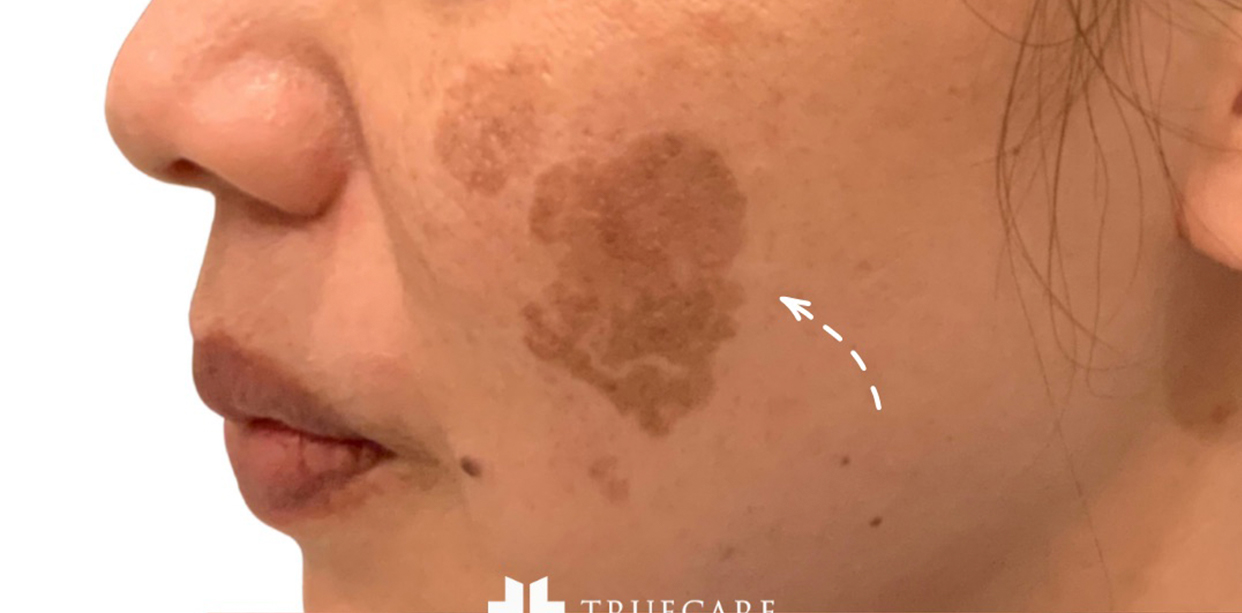 Picoway Laser before 2