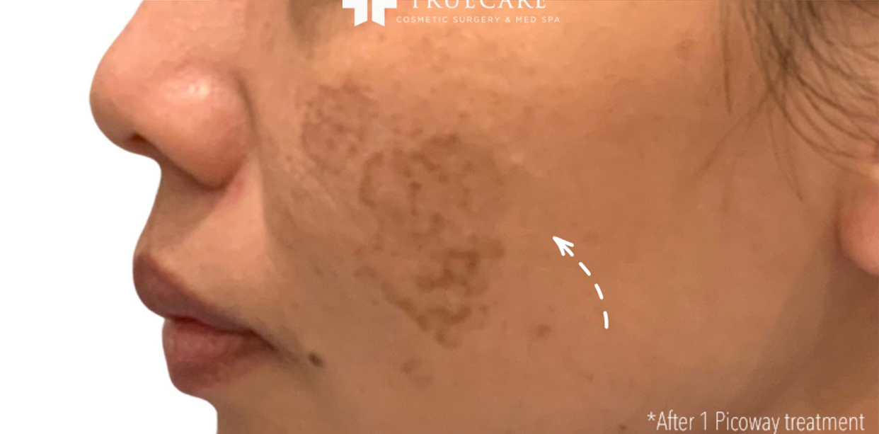 Picoway Laser after 2