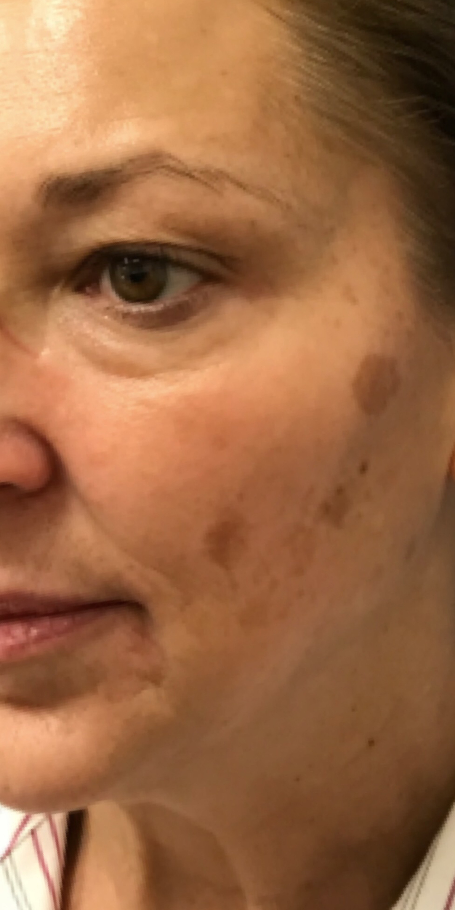 Picoway Laser before 3