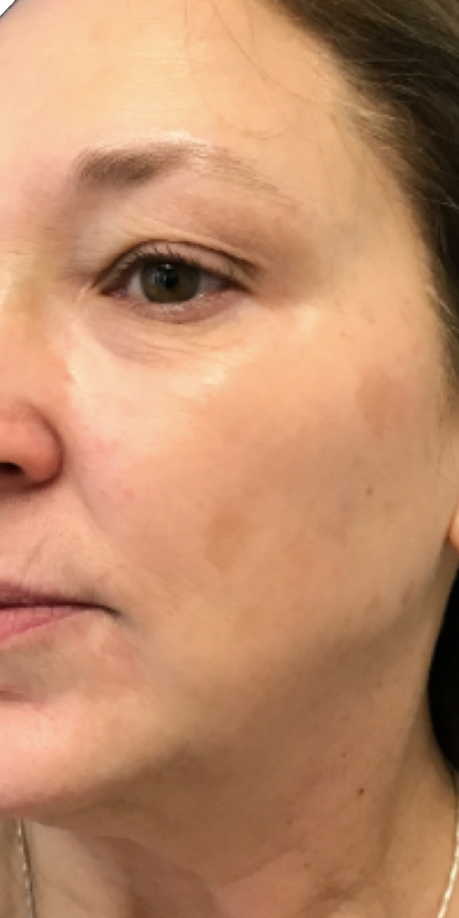 Picoway Laser after 3