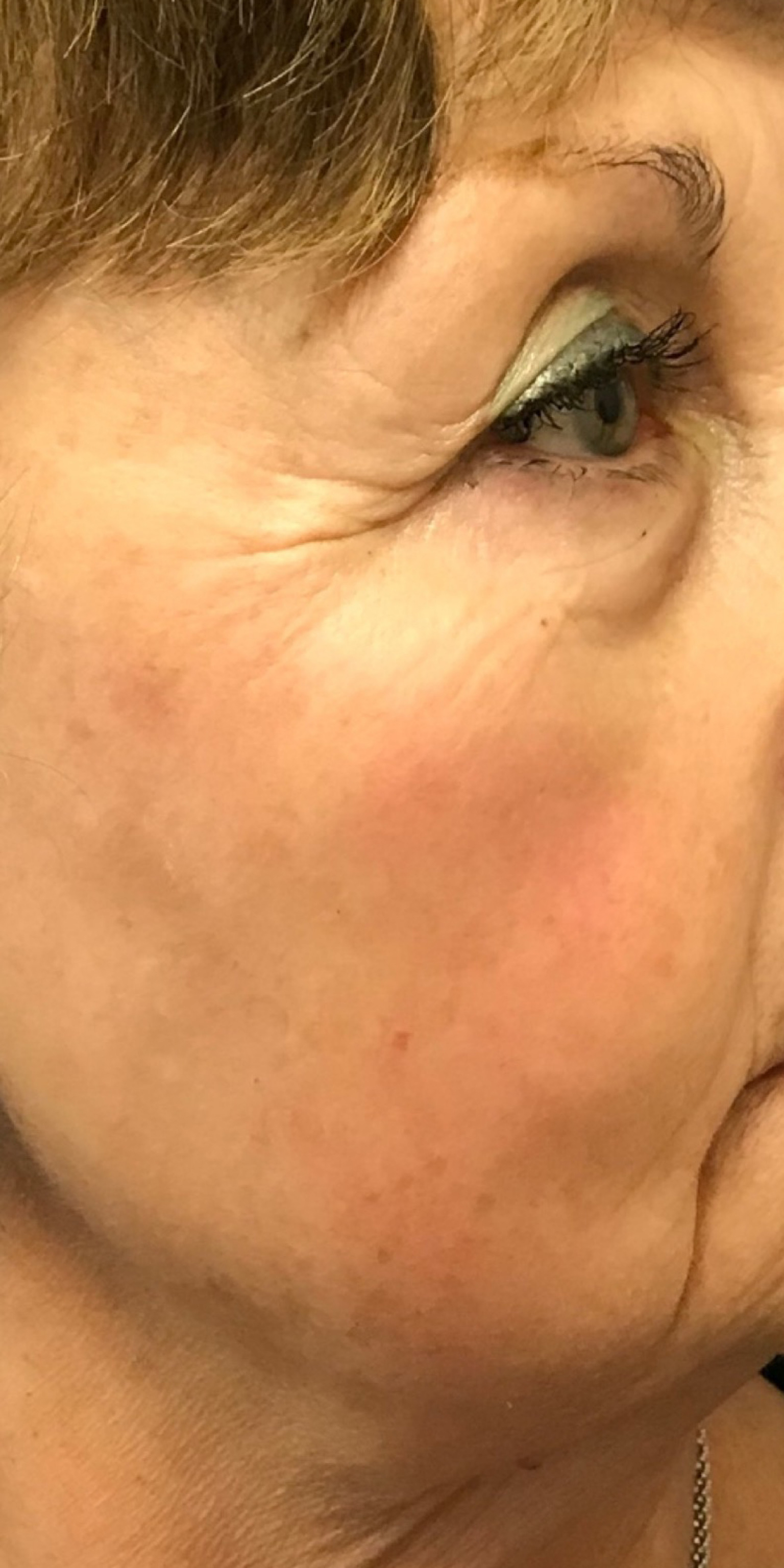 Picoway Laser after 4