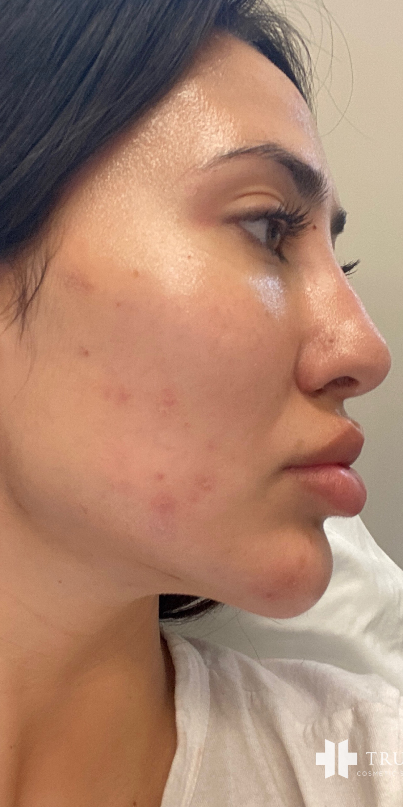 Picoway Laser before 5