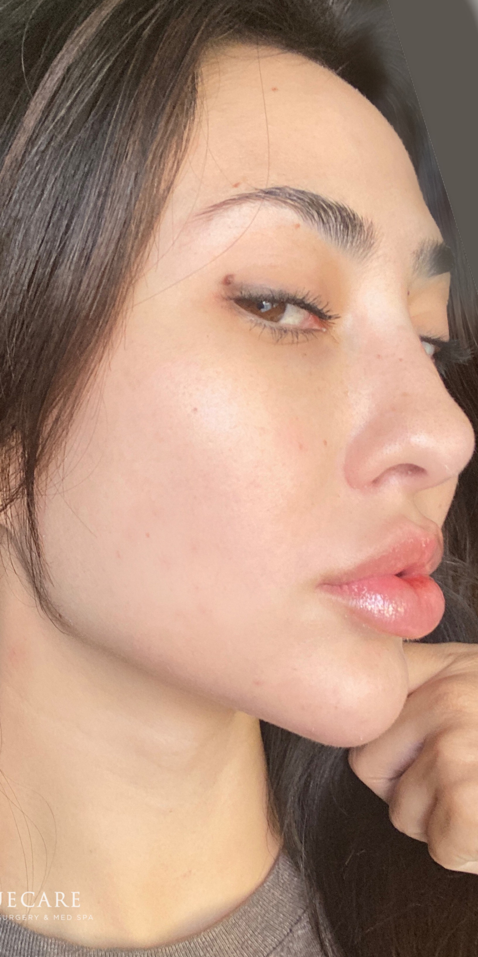 Picoway Laser after 5