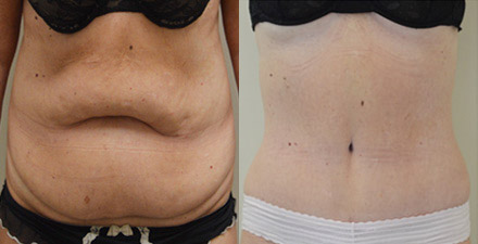 Tummy Tuck Inland Empire