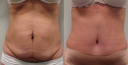 Tummy Tuck Inland Empire