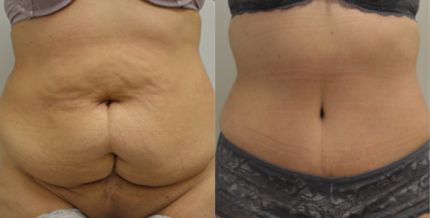 Tummy Tuck Inland Empire