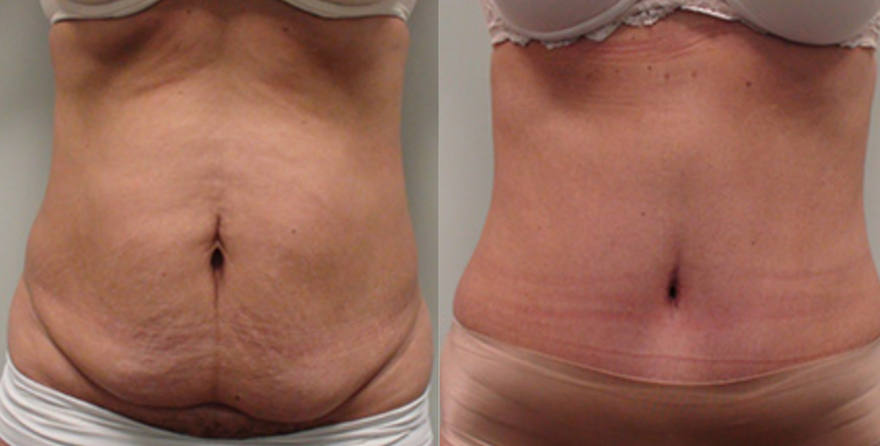 Abdominoplasty Inland Empire