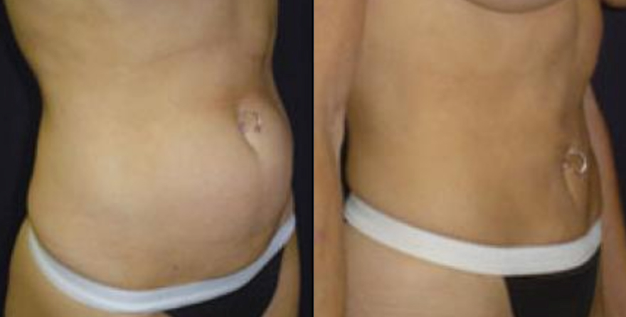 Inland Empire Tummy Tuck Patients